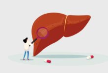 Hepatitis