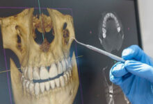 Implante Dental