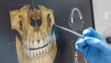Implante Dental