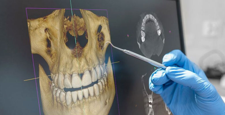 Implante Dental